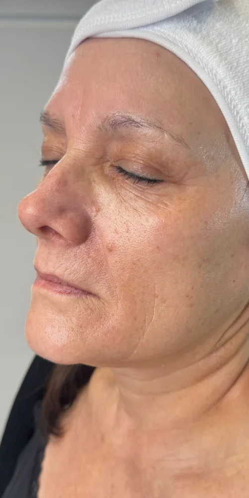 Depois do tratamento, rosto de perfil